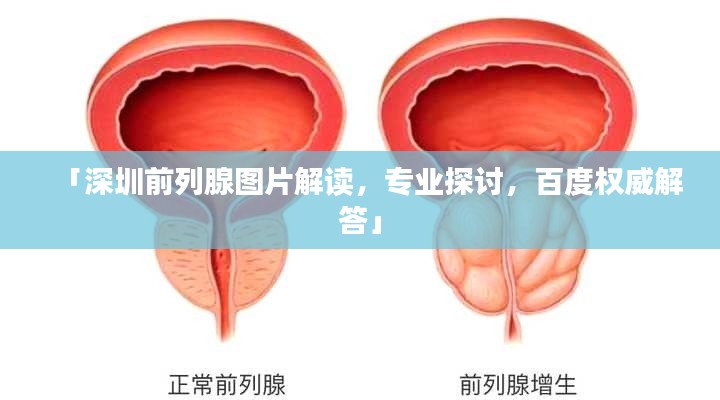 「深圳前列腺图片解读,专业探讨,百度权威解答」